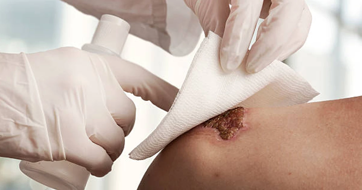 آمادهسازی اولیه برای پانسمان